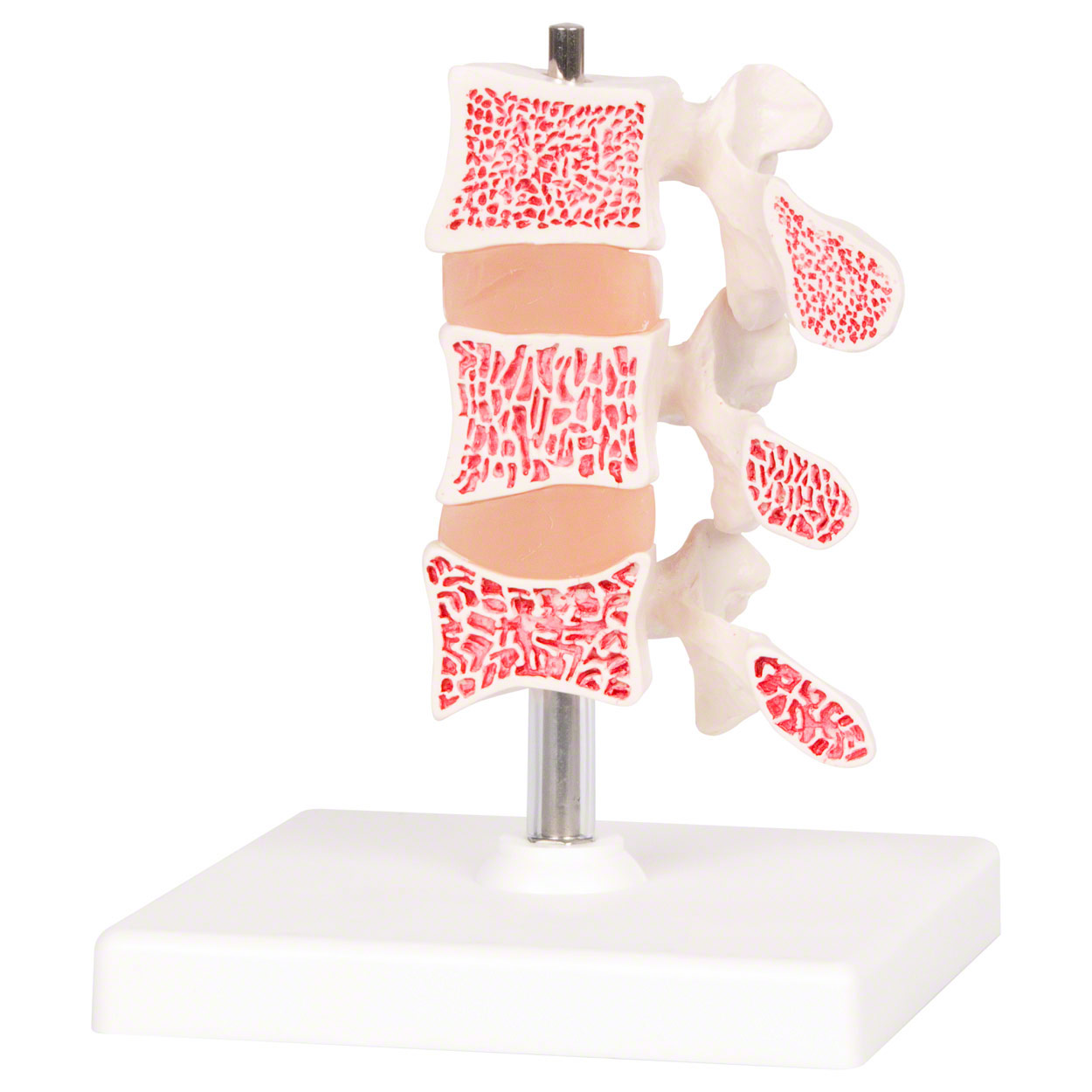 Osteoporose-Model<br> Anatomie Modelle