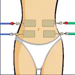 Compex Elektroden Wire, 5x10 cm, 2 Stck