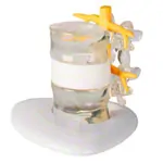 Bandscheiben-Vorfall-Simulator