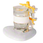 Hernie-Modell 19x19x19 cm<br> Anatomie Modelle