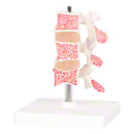 Osteoporose-Model<br> Anatomie Modelle