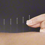 Akupunkturnadeln mit Metallgriff, 0,20x15 mm, 100 Stck