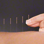 Akupunkturnadeln mit Kupferwendelgriff, 0,20x15 mm, 100 Stck