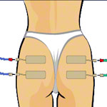 Compex Elektroden Wire, 5x10 cm, 2 Stck