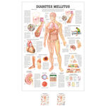 Lehrtafel Diabetes Mellitus, LxB 100x70 cm