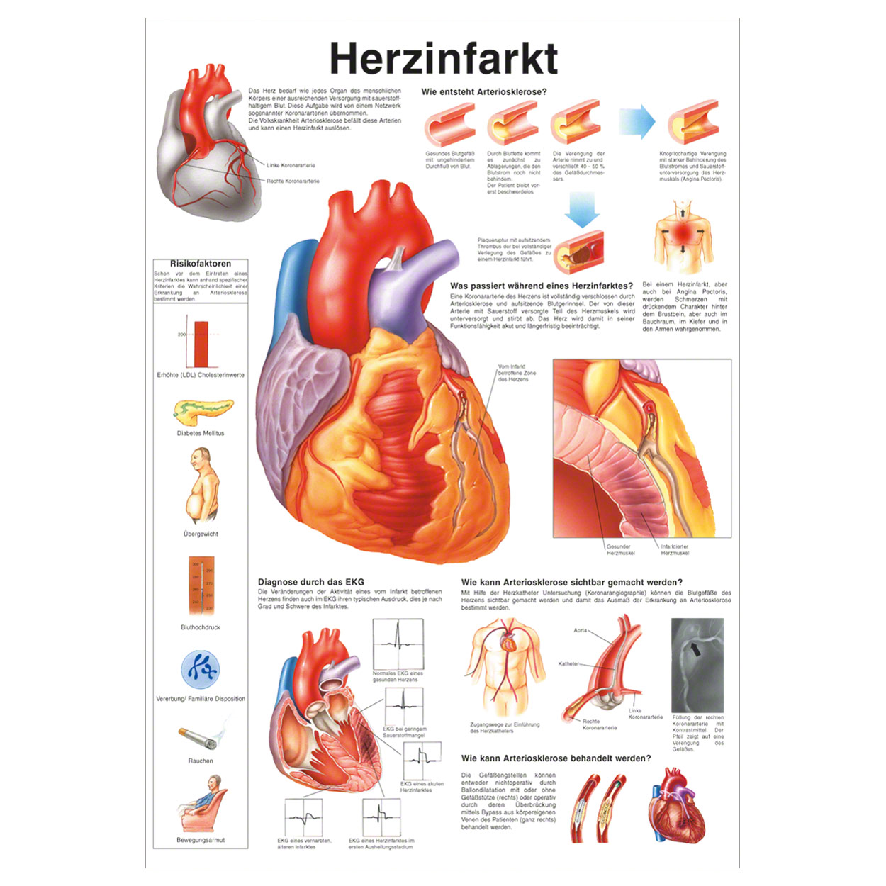 Herzinfarkt Myokardinfarkt Med Kom