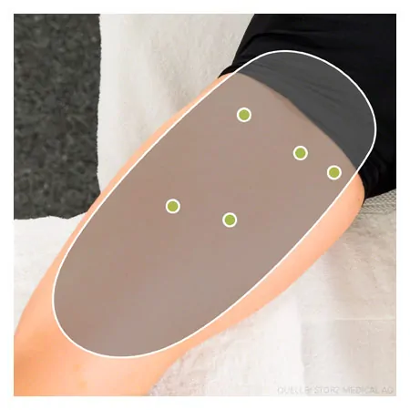 STORZ MEDICAL Stosswellentherapiegert MASTERPULS ONE