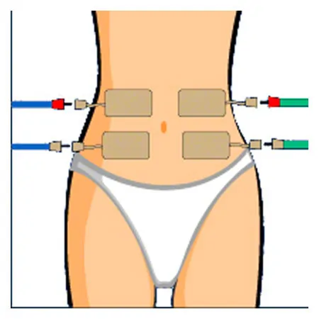 Compex Elektroden Wire, 5x10 cm, 2 Stck