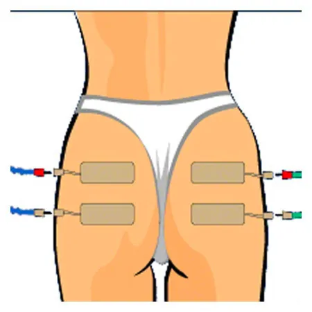Compex Elektroden Wire, 5x10 cm, 2 Stck
