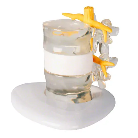 Hernie-Modell, LxBxH 19x19x19 cm