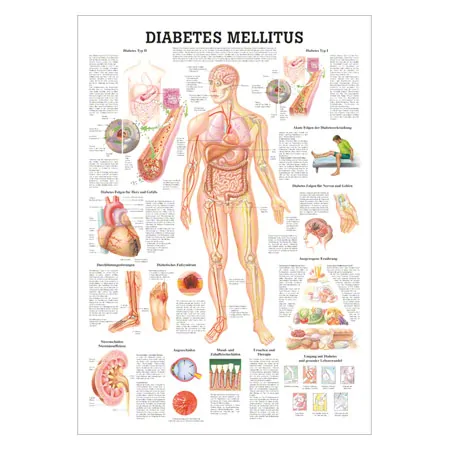 Lehrtafel Diabetes Mellitus, LxB 100x70 cm
